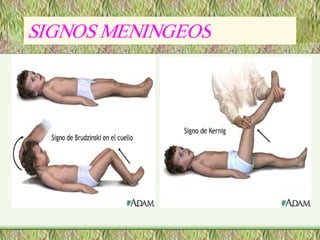 SIGNOS MENINGEOS
SIGNOS MENINGEOS 
 