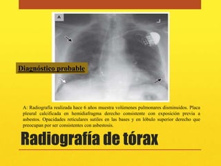 Diagnóstico probable




 A: Radiografía realizada hace 6 años muestra volúmenes pulmonares disminuidos. Placa
 pleural calcificada en hemidiafragma derecho consistente con exposición previa a
 asbestos. Opacidades reticulares sutiles en las bases y en lóbulo superior derecho que
 preocupan por ser consistentes con asbestosis.


Radiografía de tórax
 