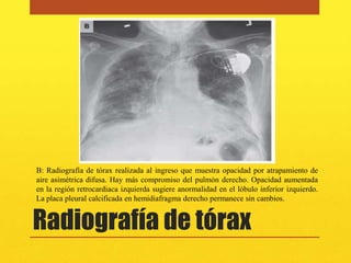 B: Radiografía de tórax realizada al ingreso que muestra opacidad por atrapamiento de
aire asimétrica difusa. Hay más compromiso del pulmón derecho. Opacidad aumentada
en la región retrocardiaca izquierda sugiere anormalidad en el lóbulo inferior izquierdo.
La placa pleural calcificada en hemidiafragma derecho permanece sin cambios.


Radiografía de tórax
 