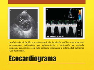 Insuficiencia tricúspide y presión ventricular izquierda sistólica marcadamente
incrementada, evidenciada por aplanamiento e inclinación de aurícula
izquierda, consistentes con falla cardiaca secundaria a enfermedad pulmonar
(Cor pulmonale).



Ecocardiograma
 