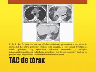 C, D, E: Tac de tórax que muestra nódulos mediatinales prominentes y sugestivos de
reactividad. La arteria pulmonar principal está alargada, lo que sugiere hipertensión
arterial pulmonar. Hay opacidades reticulares subpleurales y múltiples
quistes, predominantemente en las bases, consistentes con fibrosis pulmonar y cambios en
panal de abeja. Opacidad en vidrio esmerilado asimétrica difusa.


TAC de tórax
 