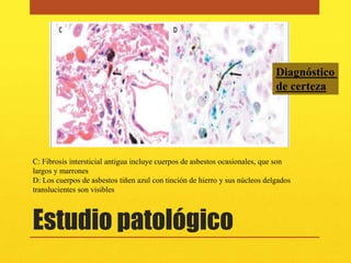Diagnóstico
                                                                             de certeza




C: Fibrosis intersticial antigua incluye cuerpos de asbestos ocasionales, que son
largos y marrones
D: Los cuerpos de asbestos tiñen azul con tinción de hierro y sus núcleos delgados
translucientes son visibles



Estudio patológico
 