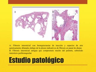 A: Fibrosis intersticial con bronquiectasias de tracción y espacios de aire
quísticamente dilatados debajo de la pleura indicativos de fibrosis en panal de abejas
B: Fibrosis intersticial antigua que compromete mucho del pulmón, sobretodo
intersticio peribronquiolar



Estudio patológico
 