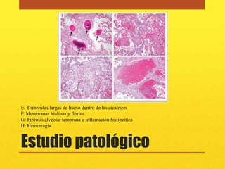 E: Trabéculas largas de hueso dentro de las cicatrices
F. Membranas hialinas y fibrina
G: Fibrosis alveolar temprana e inflamación histiocítica
H: Hemorragia



Estudio patológico
 