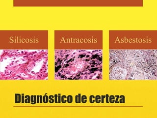 Silicosis   Antracosis   Asbestosis




 Diagnóstico de certeza
 