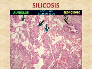 Patogenía:
El mecanismo de la fibrosis se supone que es similar al
de la silicosis. La fibrosis es peribronquiolar y luego...