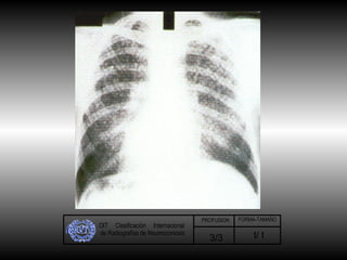 OIT  Clasificación  Internacional de Radiografías de Neumoconiosis t/ t 3/3 PROFUSION FORMA-TAMAÑO 