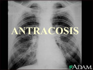 ANTRACOSIS 