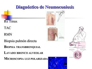 Diagnóstico de Neumoconiosis Rx Tórax TAC RMN Biopsia pulmón directa B IOPSIA   TRANSBRONQUIAL L AVADO   BRONCO ALVEOLAR M ICROSCOPIA   LUZ POLARIZADA 