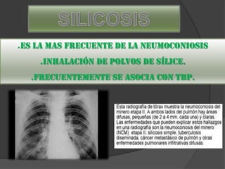 Neumoconiosis y silicosis