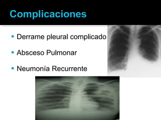 Derrame pleural complicado Absceso Pulmonar Neumonía Recurrente 