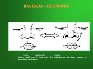 espira respiración inspira
Aleteo nasal: con la inspiración, los costados de las aletas nasales se
ensanchan hacia afuera
IRA BAJAIRA BAJA -- NEUMONÍANEUMONÍA
 