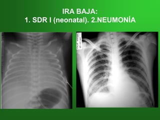 IRAIRA BAJA:BAJA:
1. SDR I (neonatal). 2.NEUMONÍA1. SDR I (neonatal). 2.NEUMONÍA
 