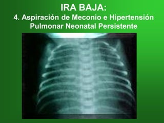 IRA BAJA:IRA BAJA:
4. Aspiración4. Aspiración dede Meconio e HipertensiónMeconio e Hipertensión
Pulmonar Neonatal PersistentePulmonar Neonatal Persistente
 