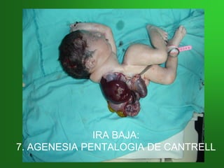 IRA BAJA:IRA BAJA:
7. AGENESIA PENTALOGIA7. AGENESIA PENTALOGIA DE CANTRELLDE CANTRELL
 