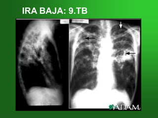 IRA BAJA: 9.TBIRA BAJA: 9.TB
 