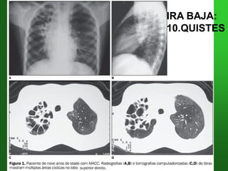 IRA BAJA:IRA BAJA:
10.QUISTES10.QUISTES
 