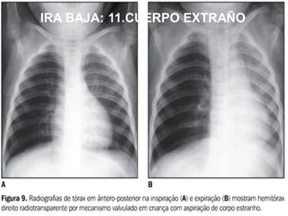 IRA BAJA: 11.CUERPO EXTRAÑOIRA BAJA: 11.CUERPO EXTRAÑO
 