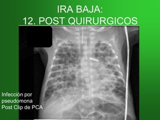 IRA BAJA:IRA BAJA:
12. POST QUIRURGICOS12. POST QUIRURGICOS
Infección por
pseudomona
Post Clip de PCA
 