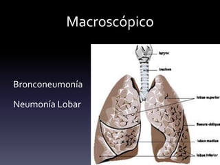 Macroscópico
Bronconeumonía
Neumonía Lobar