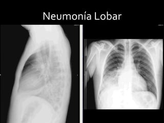 Neumonía Lobar