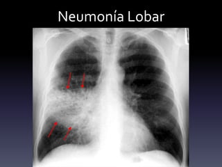 Neumonía Lobar