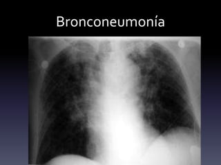Bronconeumonía