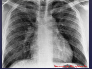 Neumonía por Mycoplasma Pn.
 