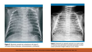 CRUZ TRATADO DE PEDIATRÍA PAG 1446 / PATOLOGÍA HUMANA ROBBINS. KUMAR ABBAS ASTER 10 Ed. PAG: 522
 