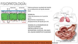 FISIOPATOLOGÍA:
Edema pulmonar resultado del retardo
en la reabsorción de líquido alveolar
fetal.
BOMBA Na
Cabio de presiones en el canal de
parto.
Movimientos respiratorios y
desplazamiento de líquido por aire.
DEMORA EN LA REABSORCION DE
LÍQUIDO PULMONAR.
OBSTRUCCIÓN DE LA VÍA
RESPIRATORIA, ALVEOLOS, POR PARTE
DEL LÍQUIDO AMNIÓTICO PULMONAR-
Avery Neonatología Diagnóstico y tratamiento del Recién nacido 7ª Edición. Mhairi g. McDonald
 