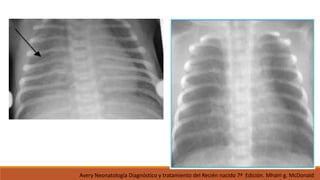 Avery Neonatología Diagnóstico y tratamiento del Recién nacido 7ª Edición. Mhairi g. McDonald
 