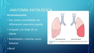 ANATOMÍA PATOLÓGICA 
Bronconeumonía 
• Son zonas consolidadas de 
inflamación supurativa aguda. 
• Irregular a lo largo de un 
lóbulo 
• Multilobular y muchas veces 
bilateral 
• Basal 
 