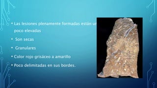 • Las lesiones plenamente formadas están un 
poco elevadas 
• Son secas 
• Granulares 
• Color rojo grisáceo a amarillo 
• Poco delimitadas en sus bordes. 
 