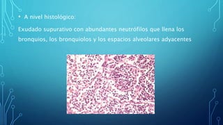 • A nivel histológico: 
Exudado supurativo con abundantes neutrófilos que llena los 
bronquios, los bronquiolos y los espacios alveolares adyacentes 
 