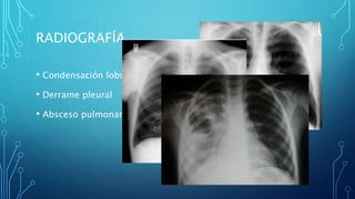 RADIOGRAFÍA 
• Condensación lobular o segmentaria única 
• Derrame pleural 
• Absceso pulmonar 
 