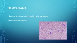 HEMOGRAMA 
• Leucocitosis con desviación a la izquierda 
• Leucopenia intensa 
 