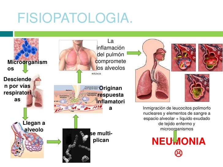 Neumonía típica