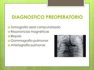 DIAGNOSTICO PREOPERATORIO
 Tomografía axial computarizada
 Resonancias magnéticas
 Biopsia
 Gammagrafía pulmonar
 Arteriografía pulmonar
 