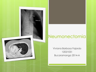 Neumonectomia
Viviana Barbosa Fajardo
12021031
Bucaramanga 2014-A
 