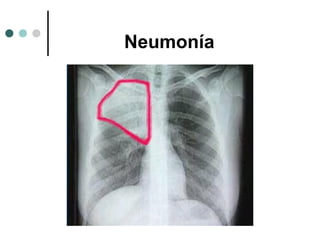 Neumonía
 