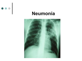 Neumonía
 