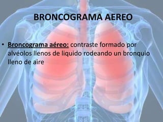 BRONCOGRAMA AEREO
• Broncograma aéreo: contraste formado por
alvéolos llenos de liquido rodeando un bronquio
lleno de aire

 