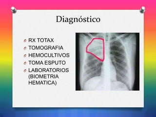 Diagnóstico
O RX TOTAX
O TOMOGRAFIA
O HEMOCULTIVOS
O TOMA ESPUTO
O LABORATORIOS

(BIOMETRIA
HEMATICA)

 