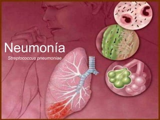 Neumonía 
Streptococcus pneumoniae 
 