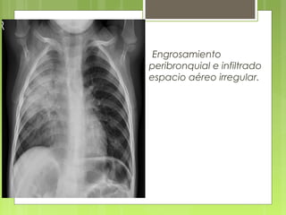 Engrosamiento
peribronquial e infiltrado
espacio aéreo irregular.
 