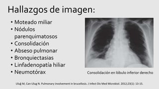 Hallazgos de imagen:
• Moteado miliar
• Nódulos
parenquimatosos
• Consolidación
• Abseso pulmonar
• Bronquiectasias
• Linfadenopatía hiliar
• Neumotórax Consolidación en lóbulo inferior derecho
Uluğ M, Can-Ulug N. Pulmonary involvement in brucellosis. J Infect Dis Med Microbiol. 2012;23(1): 13-15.
 