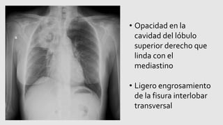 • Opacidad en la
cavidad del lóbulo
superior derecho que
linda con el
mediastino
• Ligero engrosamiento
de la fisura interlobar
transversal
 
