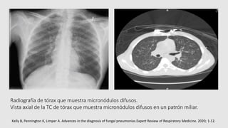 Radiografía de tórax que muestra micronódulos difusos.
Vista axial de la TC de tórax que muestra micronódulos difusos en un patrón miliar.
Kelly B, Pennington K, Limper A. Advances in the diagnosis of fungal pneumonias.Expert Review of Respiratory Medicine. 2020; 1-12.
 