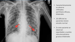 • Característicamente
se observa
infiltrados
perihilares difusos,
bilaterales
• 20-30% de los
pacientes tienen
estudio normal
• En este paciente se
observan
opacidades y quistes
reticulonodulares
gruesos bilaterales
 