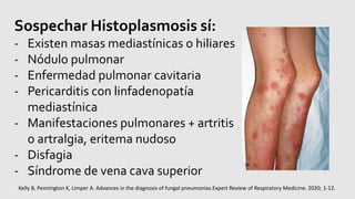 Sospechar Histoplasmosis sí:
- Existen masas mediastínicas o hiliares
- Nódulo pulmonar
- Enfermedad pulmonar cavitaria
- Pericarditis con linfadenopatía
mediastínica
- Manifestaciones pulmonares + artritis
o artralgia, eritema nudoso
- Disfagia
- Síndrome de vena cava superior
Kelly B, Pennington K, Limper A. Advances in the diagnosis of fungal pneumonias.Expert Review of Respiratory Medicine. 2020; 1-12.
 